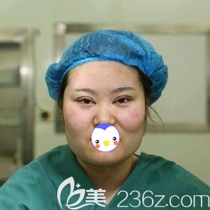 在唐山苏亚美联臣做眼综合术后双眼微肿