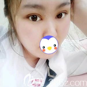 李春雷医生为我做眼综合术后10天眼睛消肿