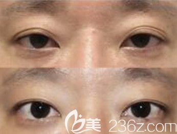 韩国艾恩医院双眼皮修复真人前后对比照