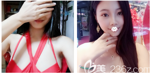 快看广州美恩医院许扬滨做隆胸怎么样 快看广州美恩医院许扬滨做隆胸怎么样