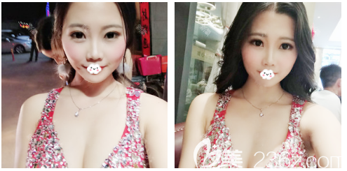 许扬滨自体脂肪隆胸术后一个月案例 许扬滨自体脂肪隆胸术后一个月案例