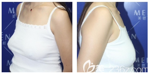 广州美恩整形医院许扬滨医生不仅鼻子做得好自体脂肪隆胸案例效果也很不错哦 广州美恩整形医院许扬滨医生不仅鼻子做得好自体脂肪隆胸案例效果也很不错哦