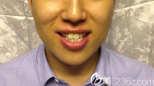 牙齿拥挤在北京佳美口腔做矫正前的照片 牙齿拥挤在北京佳美口腔做矫正前的照片