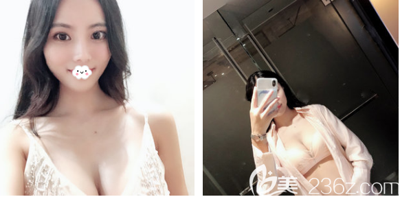 看深圳非凡整形医院隆胸效果怎么样