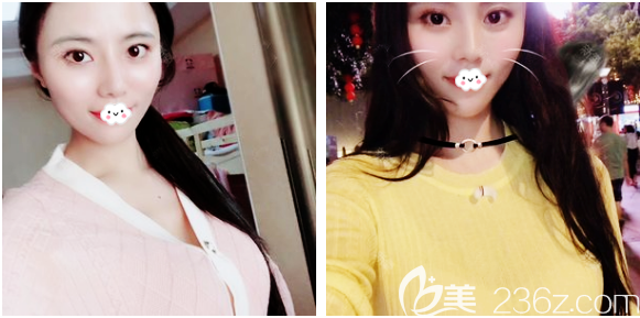 感觉身边去深圳非凡隆胸的人挺多的于是我也慕名找梅够明做了娜绮丽假体隆胸 美佳网