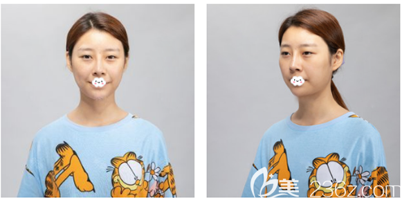 去广州曙光做双眼皮术前照片 去广州曙光做双眼皮术前照片