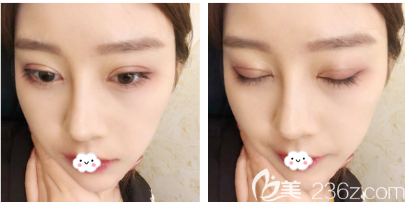 找广州曙光王娟做完双眼皮半个月了 找广州曙光王娟做完双眼皮半个月了