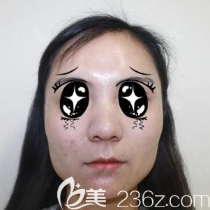 做鼻翼缩小手术前大鼻头的自己 做鼻翼缩小手术前大鼻头的自己