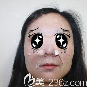 做鼻翼缩小整形术后即刻被包裹严实的自己 做鼻翼缩小整形术后即刻被包裹严实的自己