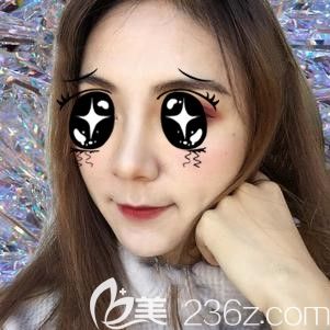 张主任帮我做鼻翼缩小术后30天鼻子消肿 张主任帮我做鼻翼缩小术后30天鼻子消肿