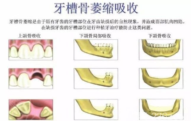 长期牙齿缺失缺失后会造成牙槽骨萎缩