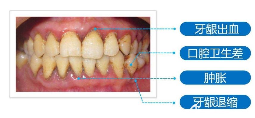 马建民院长解析:为什么有牙周病不能进行种植牙 马建民院长解析:为什么有牙周病不能进行种植牙