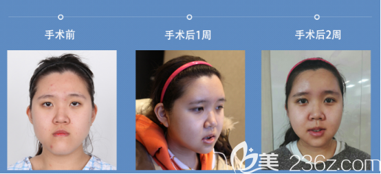 术后两周 术后两周