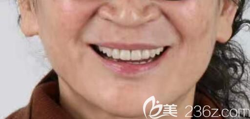 六旬老人种植全口牙后来评价北京佳美口腔即刻负重种植牙技术靠谱吗