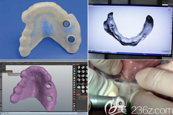 重庆牙博士口腔3D导板种植牙
