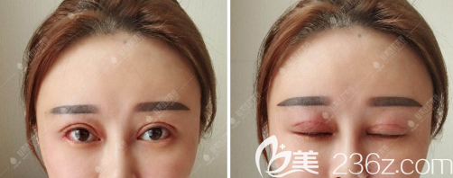 攀枝花凝美双眼皮修复手术拆线后效果