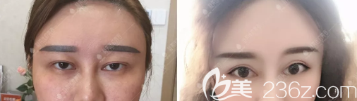 攀枝花凝美曹阳双眼皮修复对比照