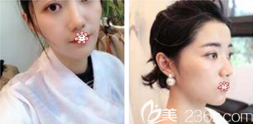 张东梅激光祛斑术后半年 张东梅激光祛斑术后半年