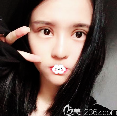 美立方张克医生双眼皮修复5天效果