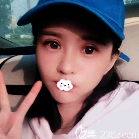 美立方双眼皮失败修复15天自拍