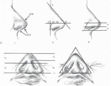 韩国清潭FIRST体旋翼鼻修复拯救做失败鼻子