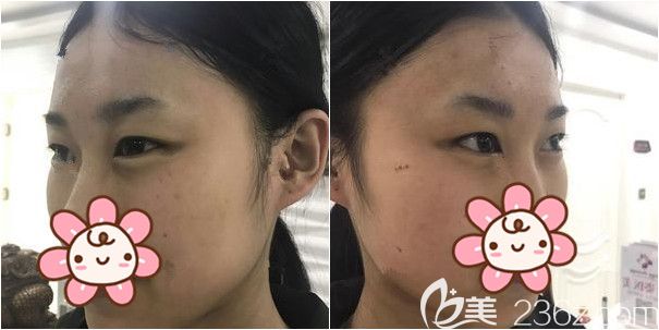 面诊孙振东医生术前单眼皮 面诊孙振东医生术前单眼皮