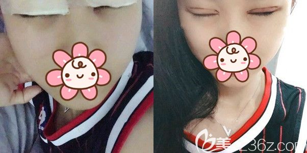 找孙振东医生做完切开重睑术后 找孙振东医生做完切开重睑术后