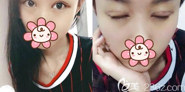 一周拆线眼睛恢复状态 一周拆线眼睛恢复状态