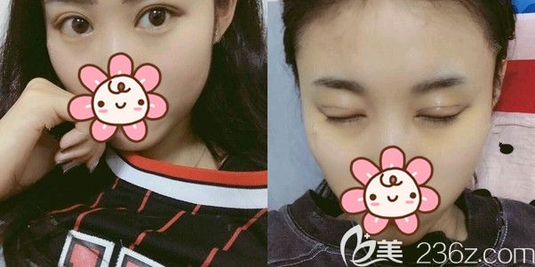 术后20多天眼睛肿胀基本消失 术后20多天眼睛肿胀基本消失