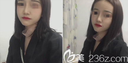 烟台华怡是一家正规的整形医院，看我在烟台华怡做的耳软骨+膨体隆鼻手术