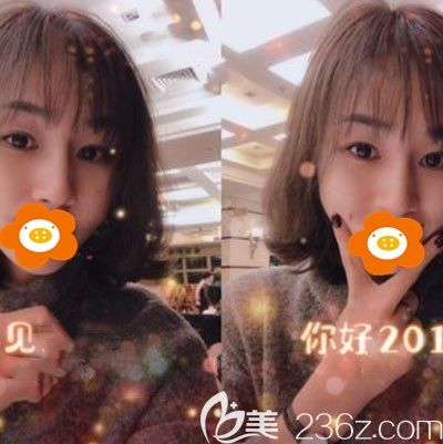 在福州比华利让林平医生做了自体肋软骨综合隆鼻后拯救了我的塌鼻梁