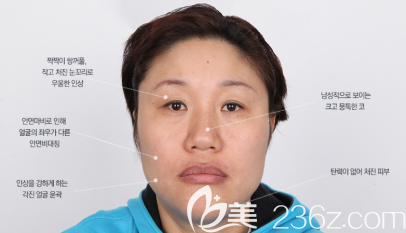 术前面部照片 术前面部照片