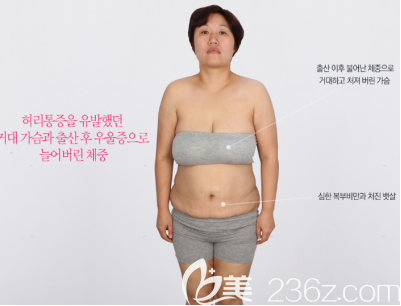 吸脂前照片 吸脂前照片