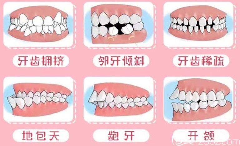 哪些牙齿情况适用于舌侧矫正