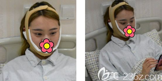 兰州时光逯岩面部吸脂第2天效果