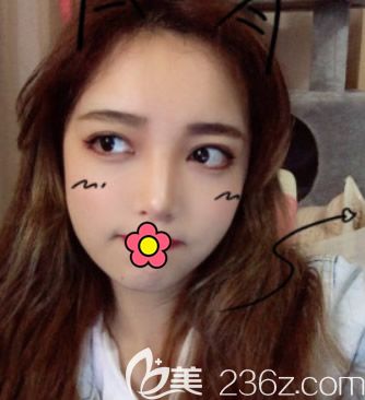 面部吸脂做完10天图片