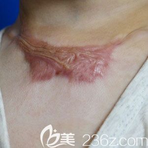 武汉正璞疤痕整复医疗美容去疤痕术前 武汉正璞疤痕整复医疗美容去疤痕术前