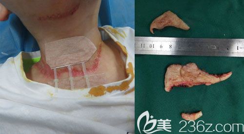 武汉正璞疤痕去除手术后当天 武汉正璞疤痕去除手术后当天