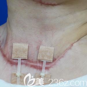 武汉去疤痕哪家医院好?正璞疤痕整复祛疤案例 武汉去疤痕哪家医院好?正璞疤痕整复祛疤案例