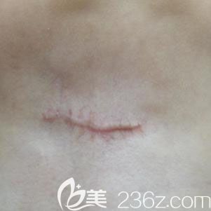 我在武汉正璞疤痕整复医疗美容做过疤痕切除1年后将去疤痕手术价格与经历分享下