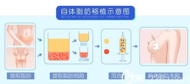 自体脂肪丰胸原理示意图