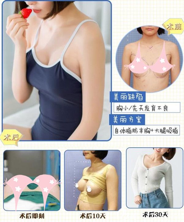 在苏州康美做过自体脂肪丰胸前后对比