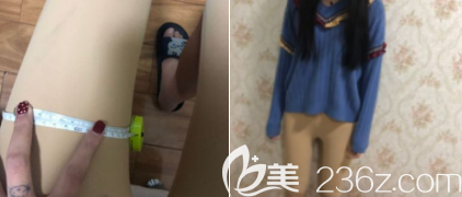 术后7天 术后7天