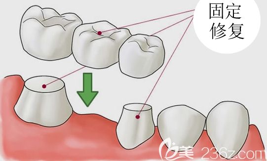 马丹军科普可摘活动义齿和固定义齿哪个好