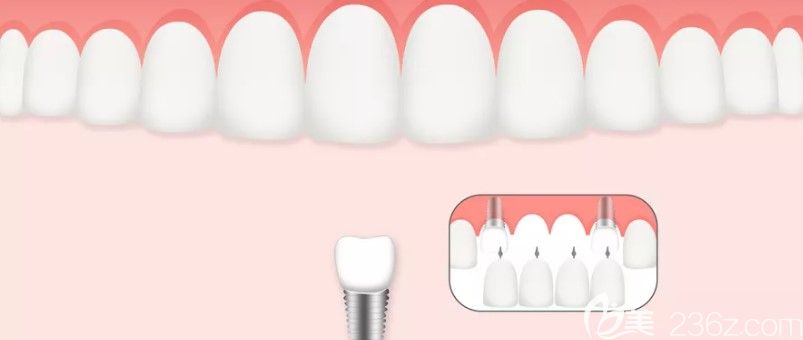 上下颌骨条件不好的顾客是可以做种植牙的 上下颌骨条件不好的顾客是可以做种植牙的
