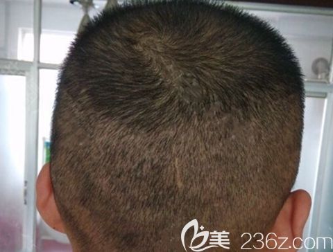 植发后取发区恢复图片 植发后取发区恢复图片