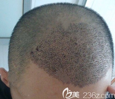 广州碧莲盛术后5天 广州碧莲盛术后5天