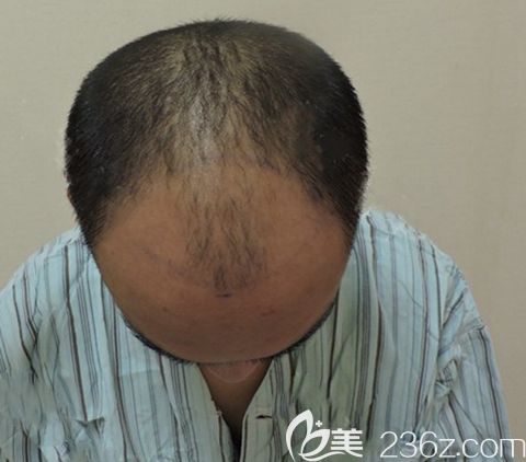 广州碧莲盛头顶加密种植 广州碧莲盛头顶加密种植