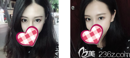 自从我在德州天宏做了全切双眼皮之后我就成了他们家的铁粉了