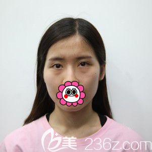 做自体脂肪面部填充前 做自体脂肪面部填充前